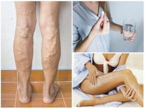 Varicose veins on the legs and treatment methods