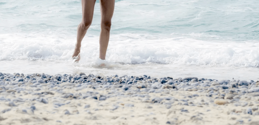 varicose veins