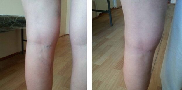 varicose veins on the legs