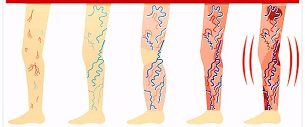 what not to do with varicose veins