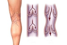 outflow of blood in varicose veins at different stages of disease development