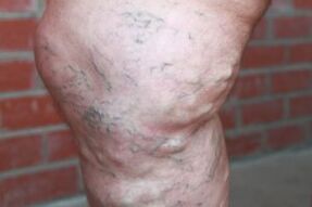 possible complications of advanced varicose veins in the legs